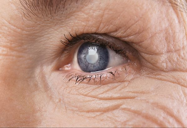 a doctor evaluating a patient's vision before cataract surgery