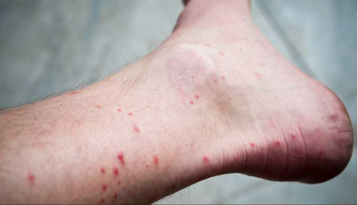 a person with red bumps on their leg from flea bites