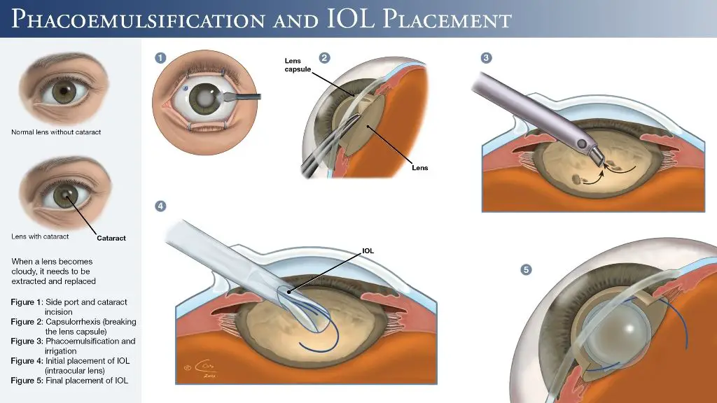 a step-by-step illustration of phacoemulsification cataract surgery