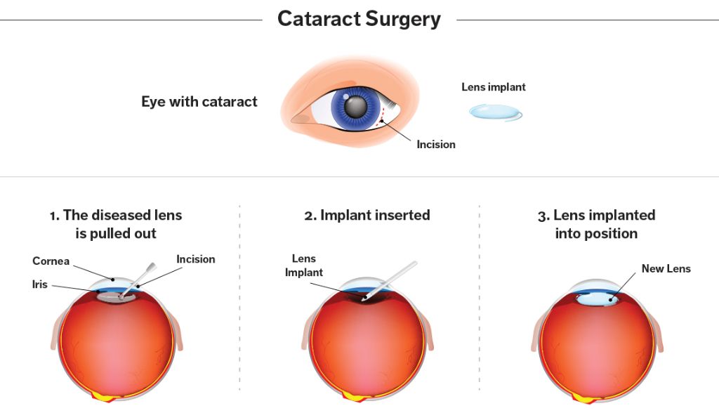 an infographic showing different types of cataract surgery