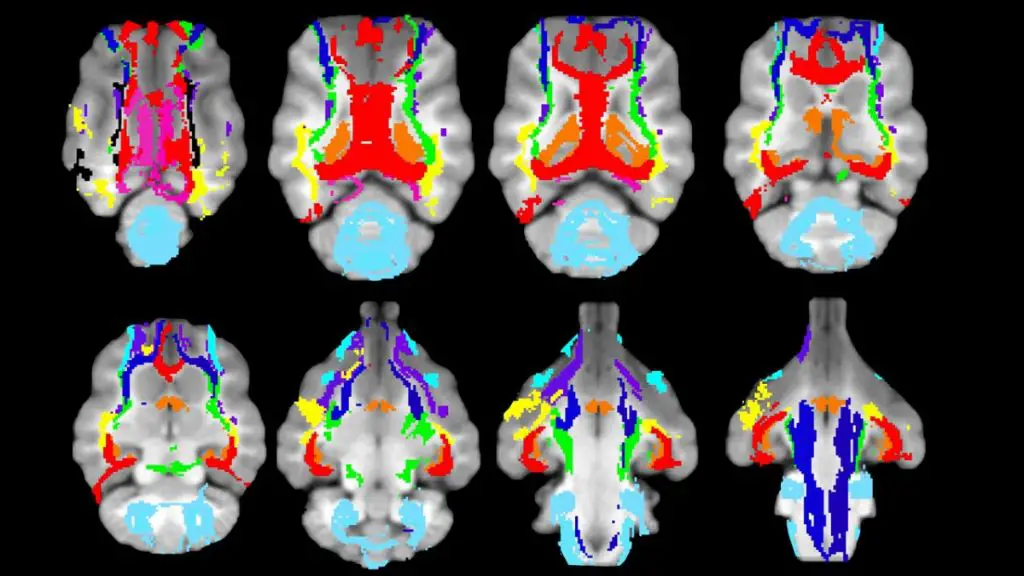 brain scan image