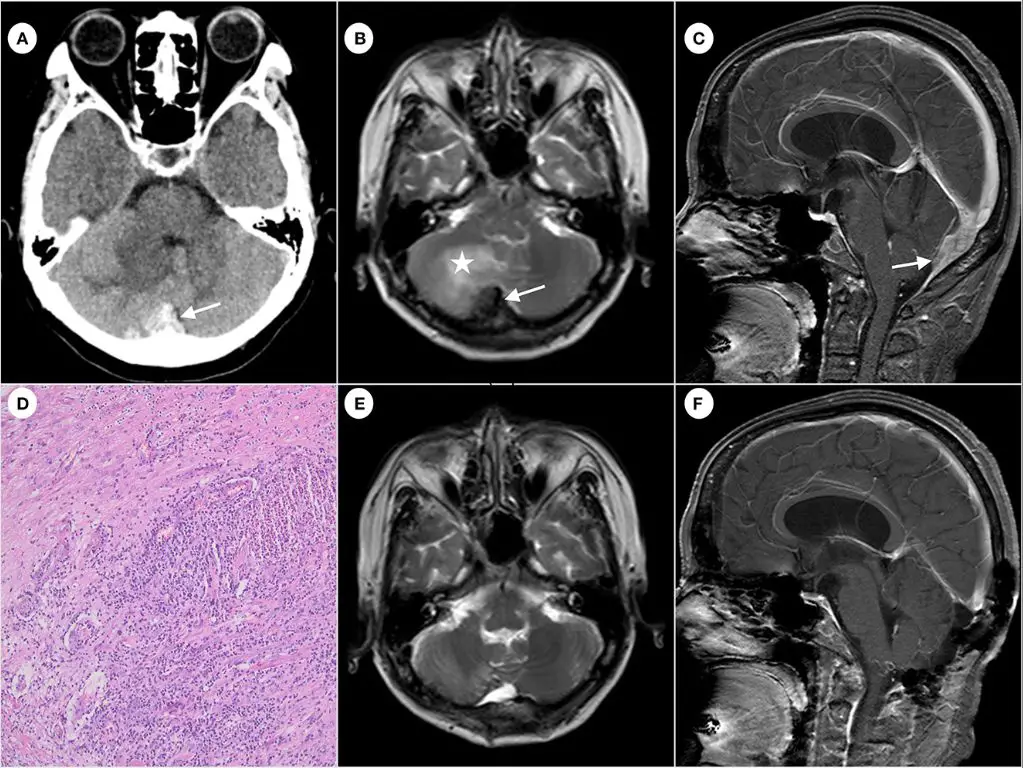 brain scan showing inflammation