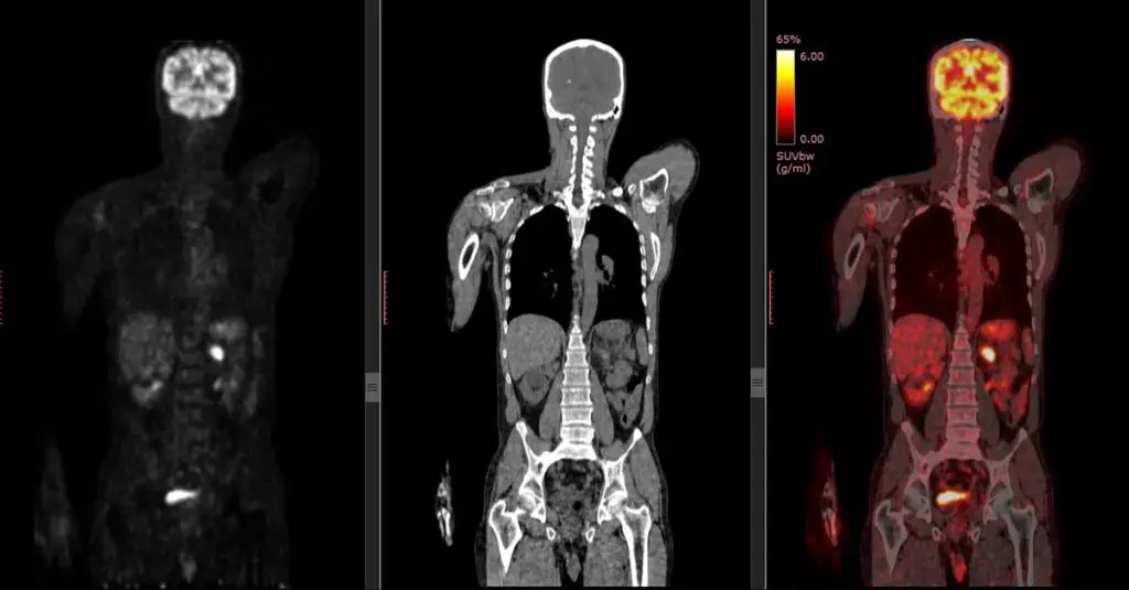 cat scans detect tumors in chest and abdomen