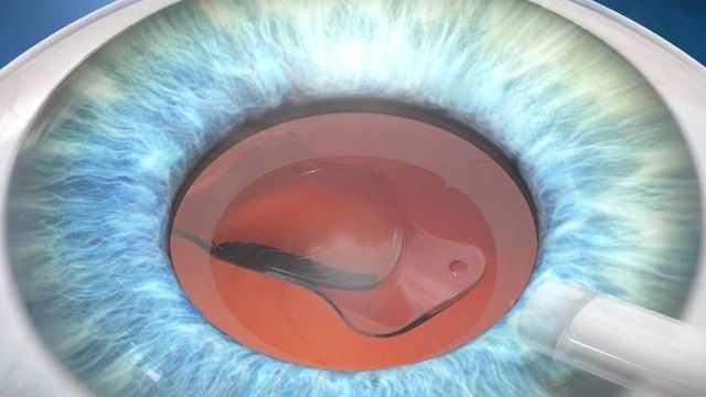 cataract surgery removes cloudy lens and implants artificial iol