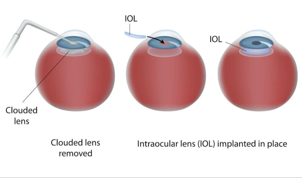 cataract surgery removes the cloudy lens and inserts an artificial one