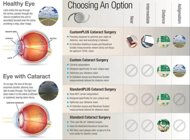 consider lifestyle factors when deciding cataract surgery timing
