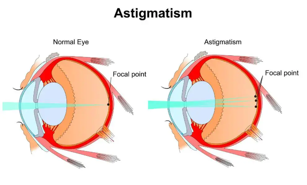 diagram comparing a normal eye and an eye with astigmatism