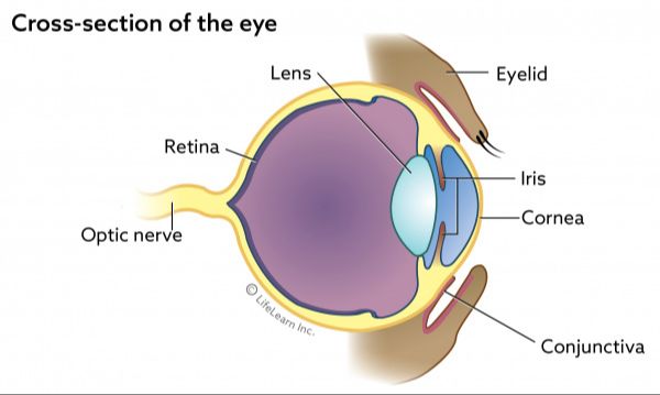 diagram of a normal eye vs. an eye with a cataract