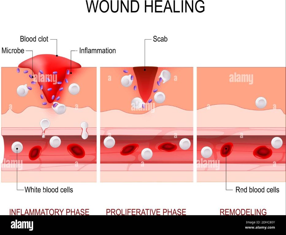 diagram of the stages of wound healing