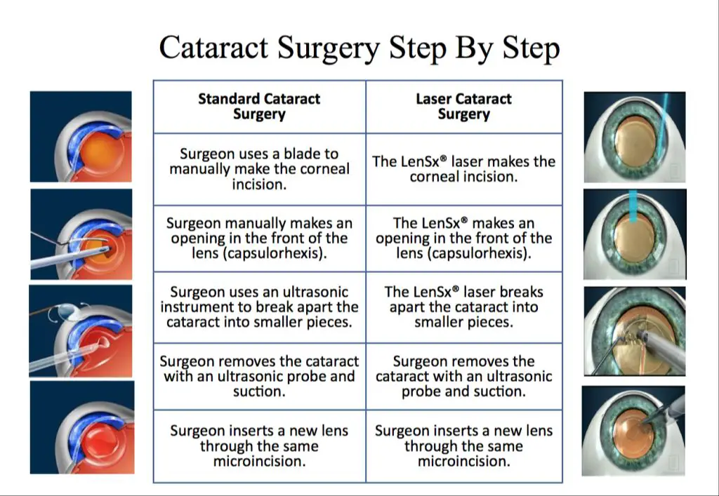 diagram showing laser cataract surgery steps
