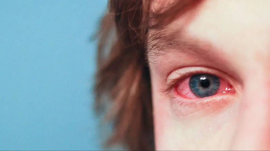 human eye irritation caused by cat allergies
