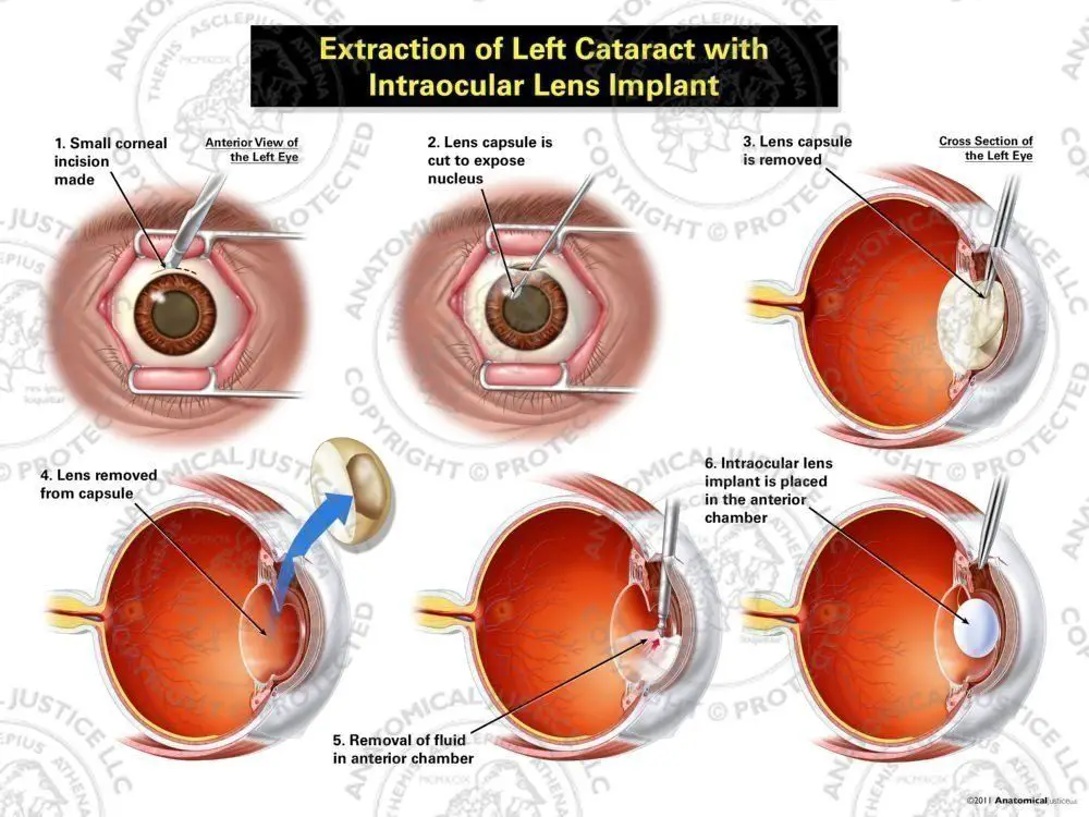 intracapsular cataract extraction