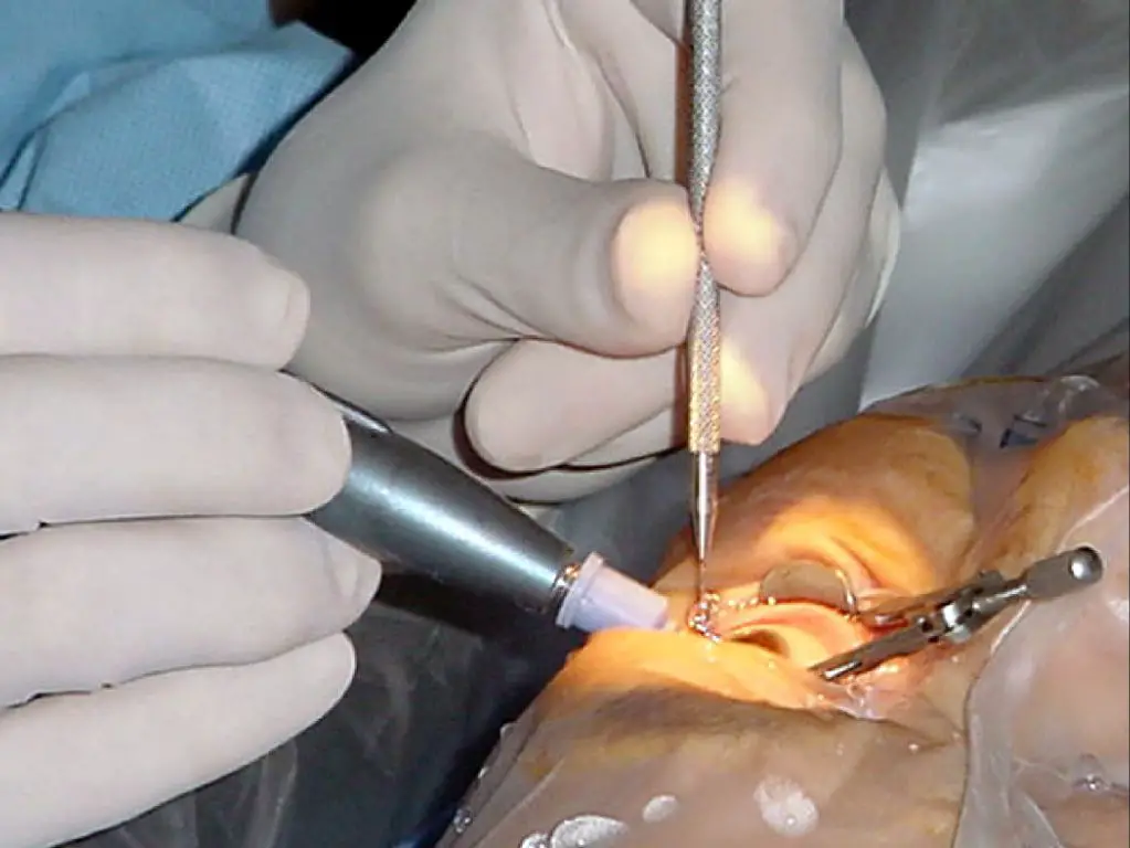 person undergoing a standard cataract surgery