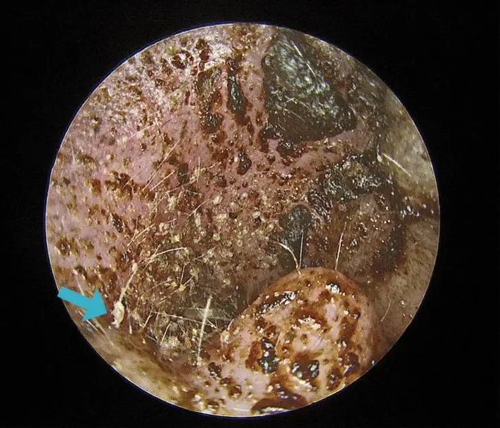 person with inflamed irritated ear from a mite infestation