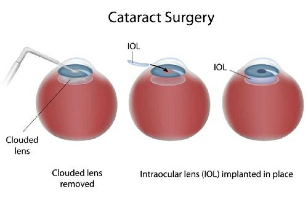 some dependence on glasses may remain after cataract surgery