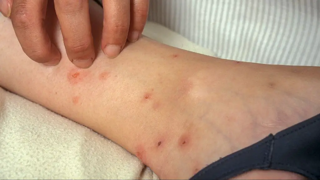 someone scratching an itchy flea bite on their arm