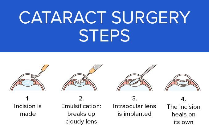 steps in traditional cataract surgery
