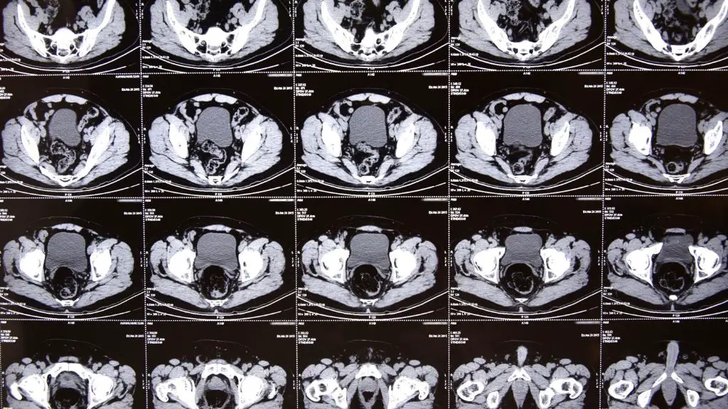 studies show cancer risk from ct scans