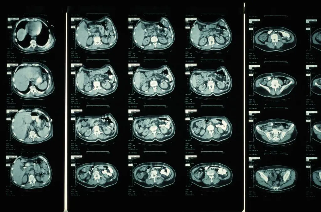 using ct scans to diagnose cancer